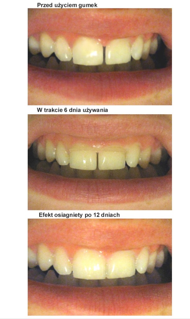 USUŃ SZPARĘ MIĘDZY ZĘBAMI gumki gapbands