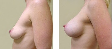 BREAST FAST ТАБЛЕТКИ ДЛЯ УВЕЛИЧЕНИЯ ГРУДИ