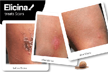 ELICINA крем для слизи улитки SCAR ACNE + СЫВОРОТКА